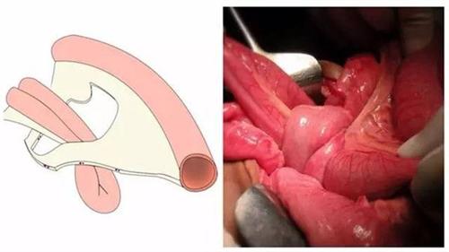 腹内疝
