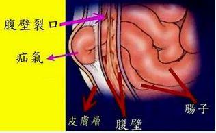 腹内疝
