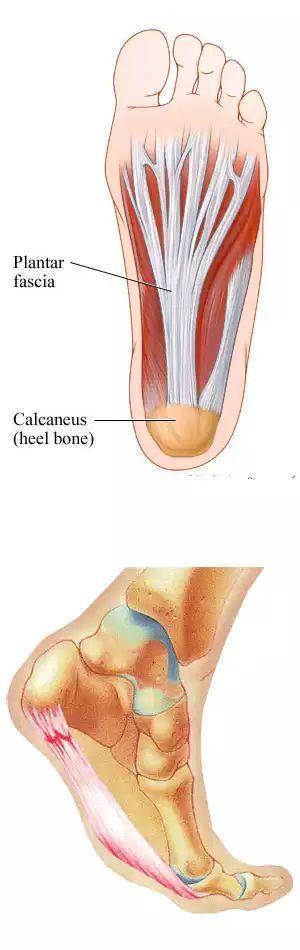 足底筋膜炎