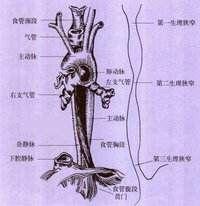 食管异位组织