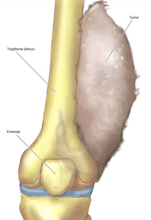 骨肉瘤