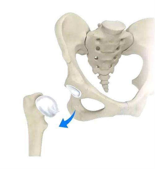 髋关节脱位