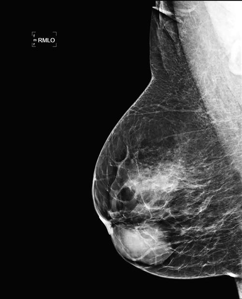 乳房纤维腺瘤