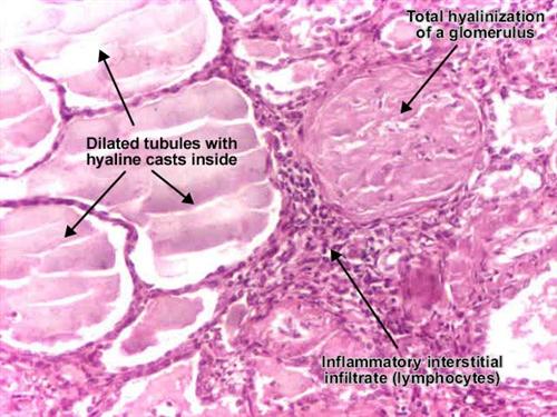 慢性肾小球肾炎