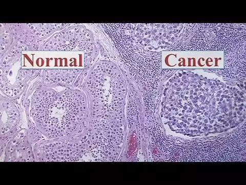 睾丸癌