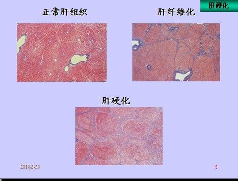肝肺综合症