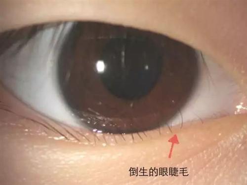 倒睫