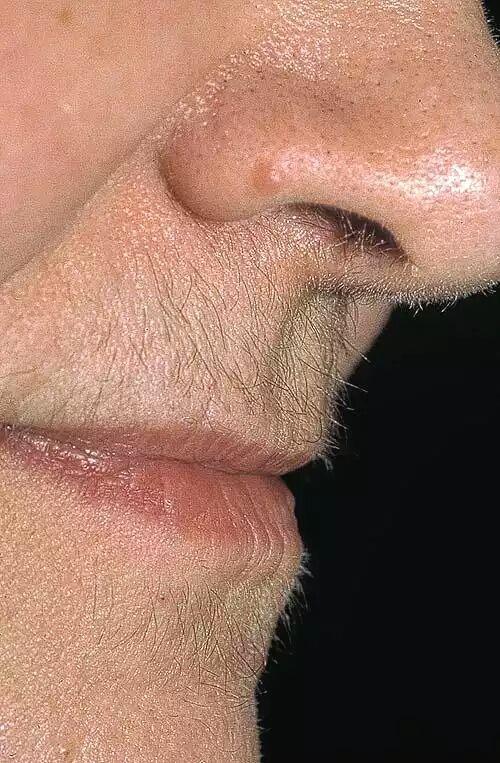 多毛症