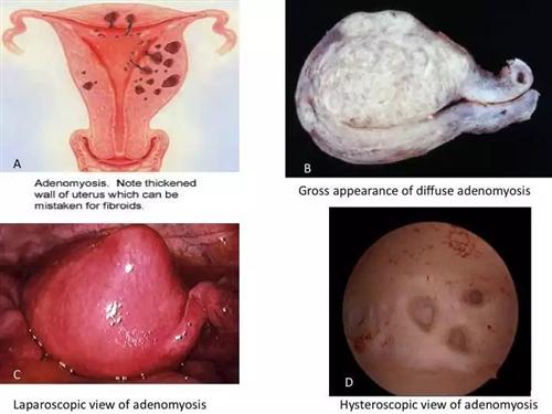 子宫腺肌症