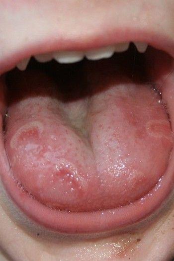 小儿口腔溃疡