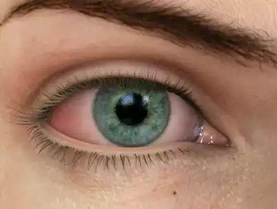 干眼