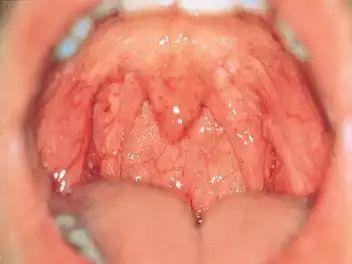 慢性单纯性咽炎