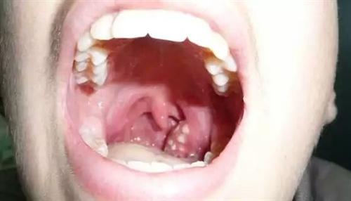 慢性单纯性咽炎