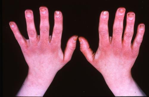手部湿疹