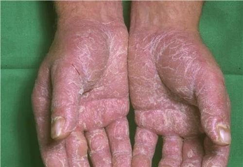 手部湿疹