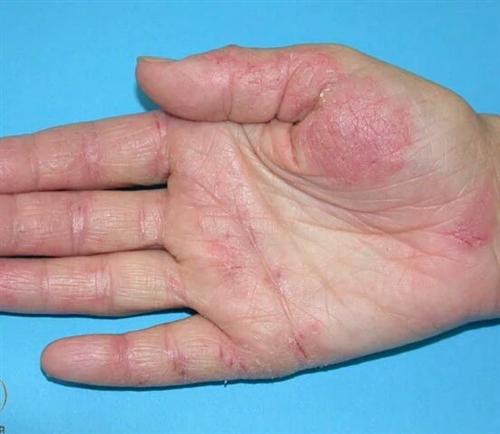 手部湿疹