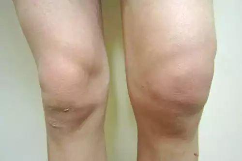 滑囊炎