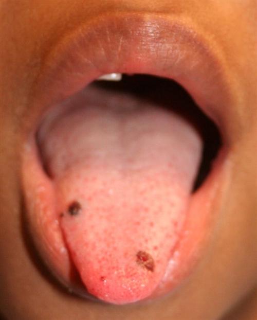 特发性血小板减少性紫癜