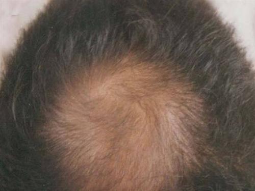 生长期脱发