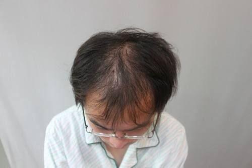 生长期脱发