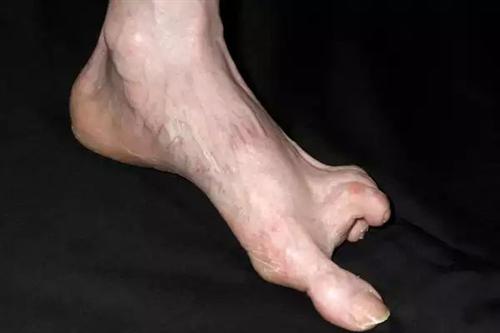 硬皮病