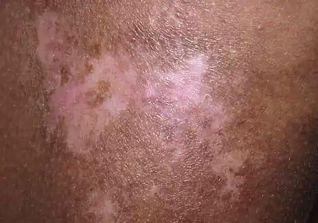 结缔组织病