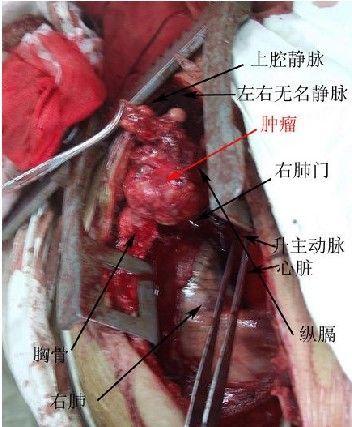 胸内甲状腺肿