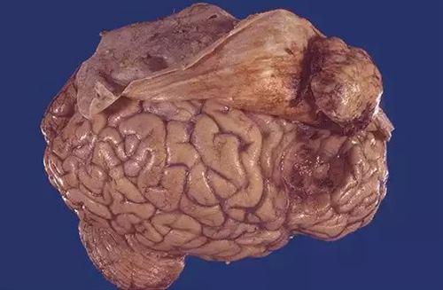 脑膜瘤