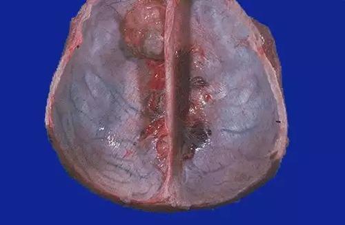 脑膜瘤