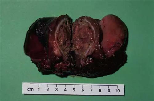 卵巢浆液性囊腺瘤