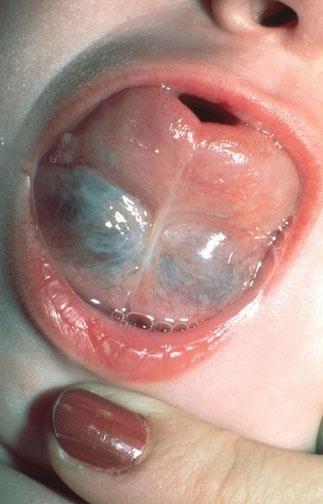 舌下腺囊肿