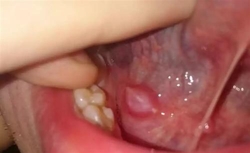 舌下腺囊肿