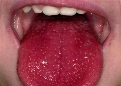 舌病