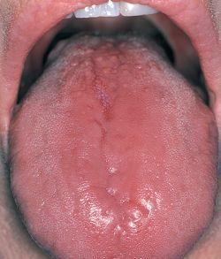 舌病