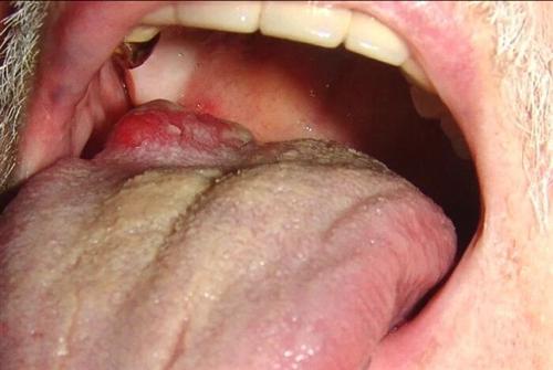 舌癌