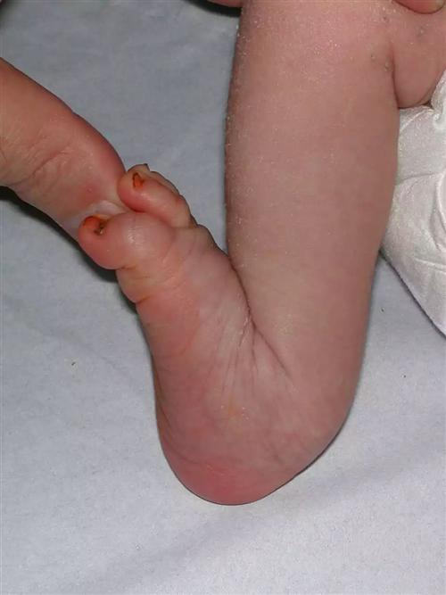 足外翻