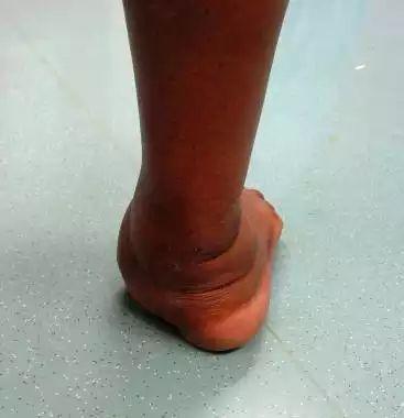 足外翻