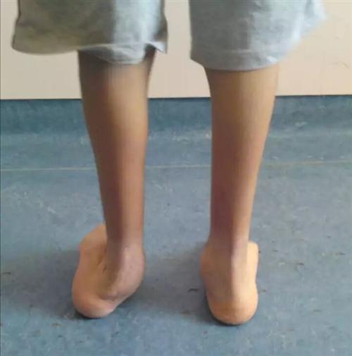 足外翻