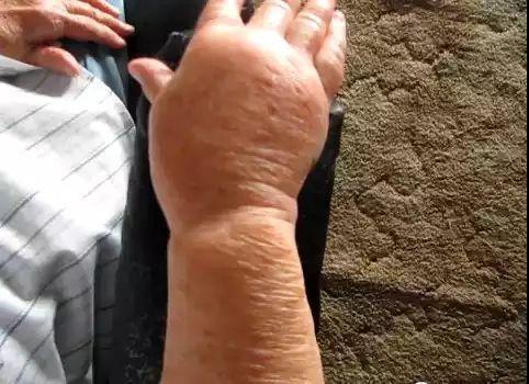 静脉炎