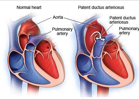 动脉导管未闭