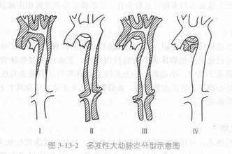 动脉炎