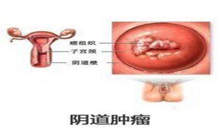 外阴卵黄囊瘤