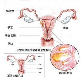 子宫内膜不规则脱落