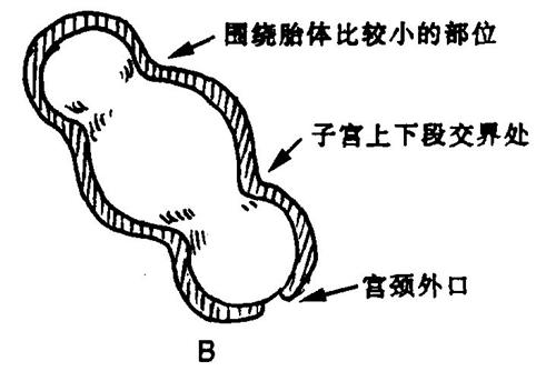 子宫收缩过强