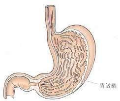 急性腐蚀性胃炎