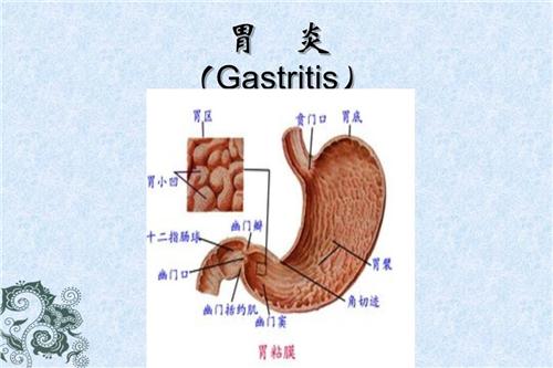 急性腐蚀性胃炎