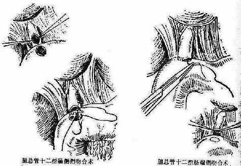 慢性胆管炎