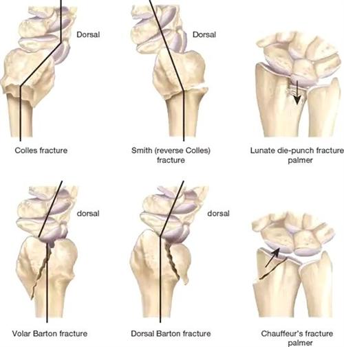 桡骨远端骨折