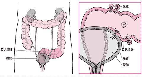 结肠憩室病