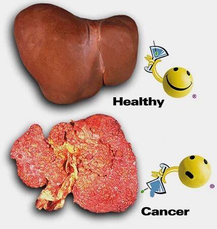 肝癌
